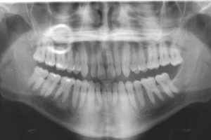 Bitewing and Panoramic dental x-rays are performed at Corpus Christi dentist Dr. Russell Borth's office