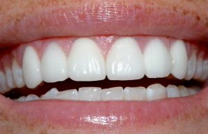 Dental Bridges at Dr. Russell D. Borth of Corpus Christi