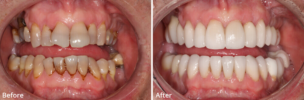 Russell D. Borth DDS does Porcelain Veneers